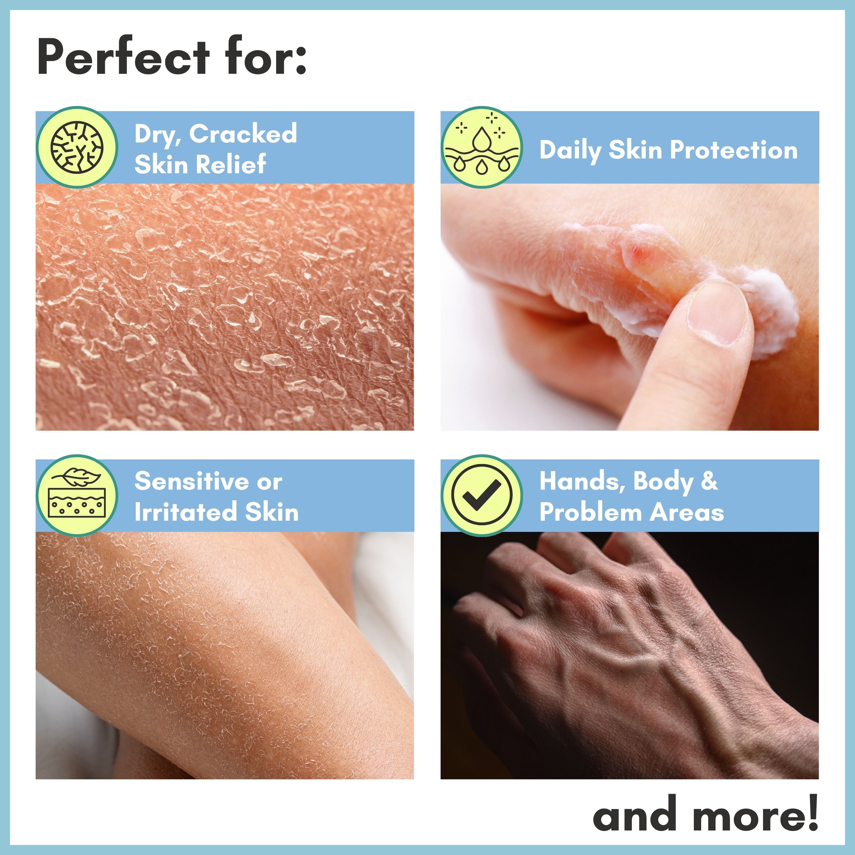 Skin Repair Cream for Dry, Cracked Hands, Feet & Elbows